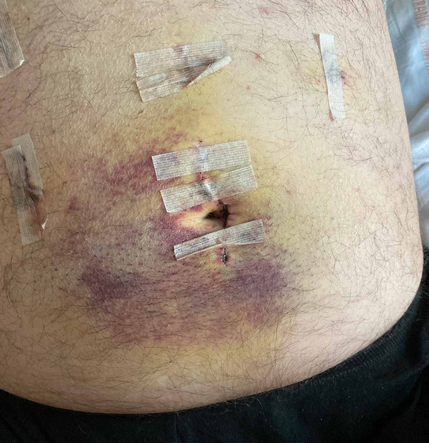 elfbar nachfüll pod läuft aus Chirurgie de la vésicule biliaire